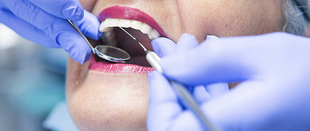 Best Emergency Dentist for Lost Fillings or Crowns in Benton, TN